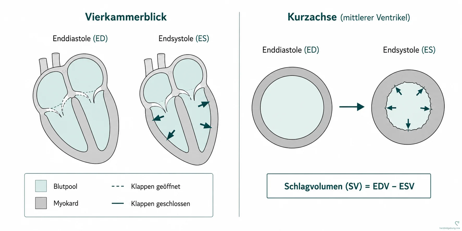 Schematische Darstellung der Cine-Volumetrie im Vierkammerblick und in der Kurzachse: Enddiastole und Endsystole als Grundlage für Schlagvolumen (SV = EDV minus ESV) und Ejektionsfraktion