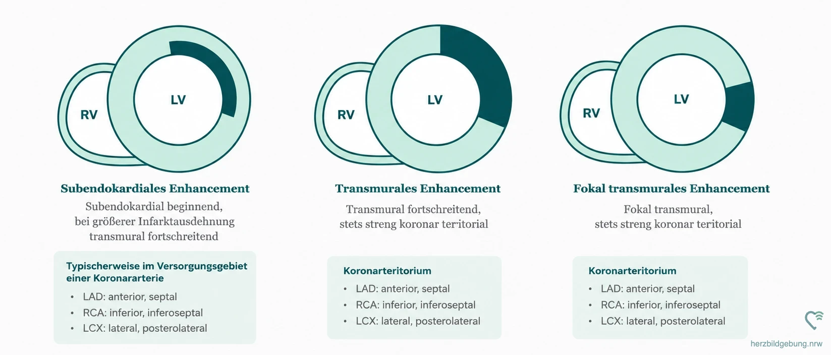 Ischämische LGE-Verteilungsmuster: subendokardiales Enhancement, transmurales Enhancement und fokal transmurales Enhancement, jeweils streng koronarterritorial