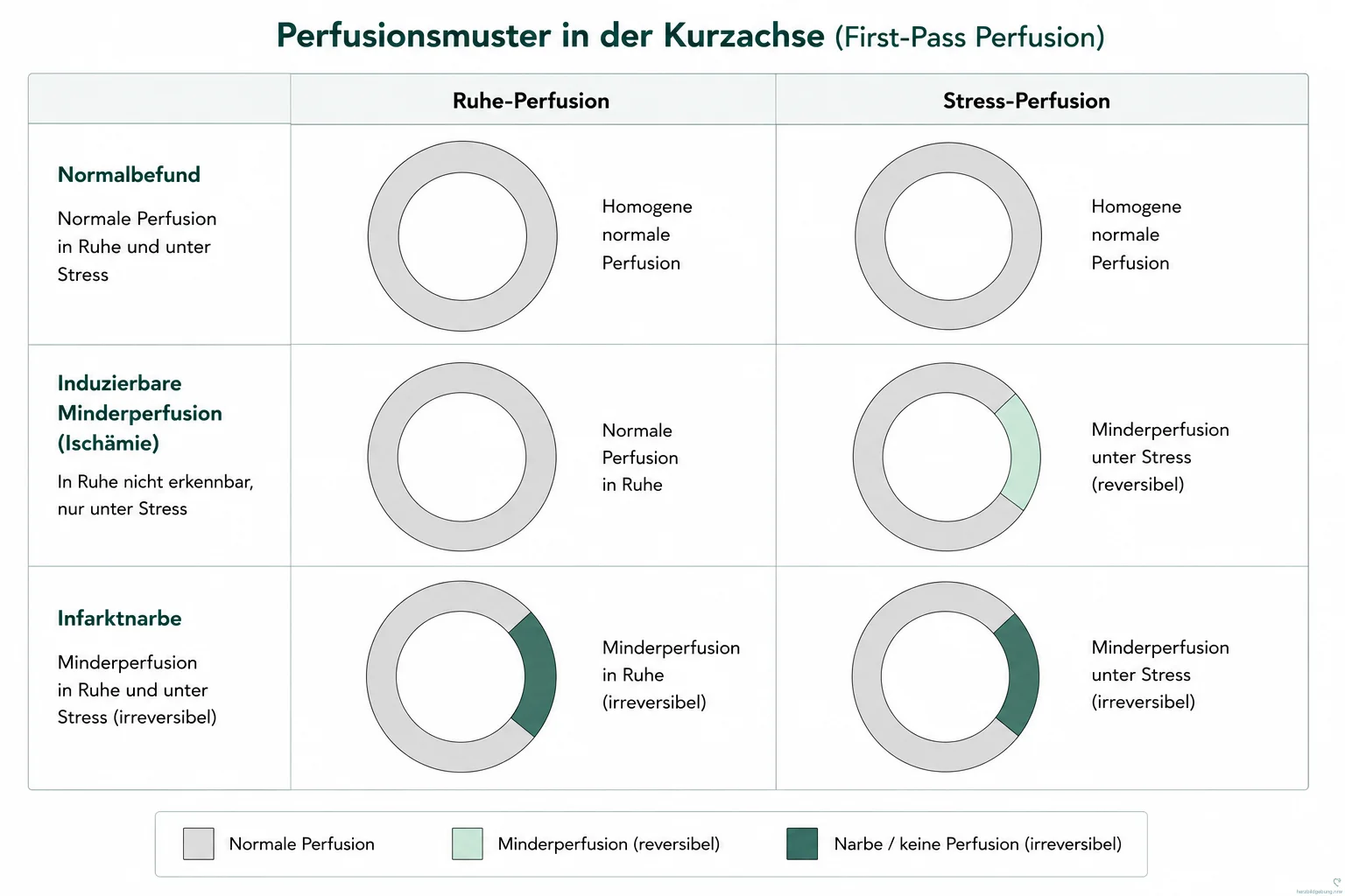 Perfusionsmuster in der Kurzachse (First-Pass-Perfusion): Vergleich von Ruhe- und Stress-Perfusion bei Normalbefund, induzierbarer Minderperfusion (Ischämie) und Infarktnarbe
