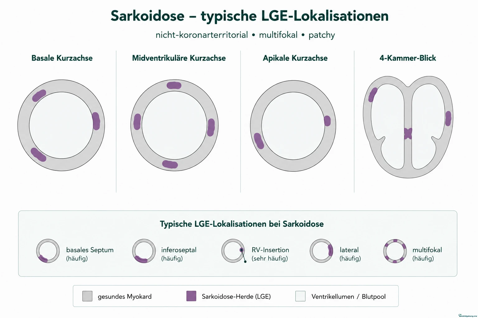 Typische LGE-Lokalisationen bei kardialer Sarkoidose in Kurzachse und 4-Kammer-Blick: mittmyokardial bis subepikardial betontes, nicht-koronarterritoriales, multifokales Verteilungsmuster an basalem Septum, inferoseptal, lateral und am RV-Insertionspunkt
