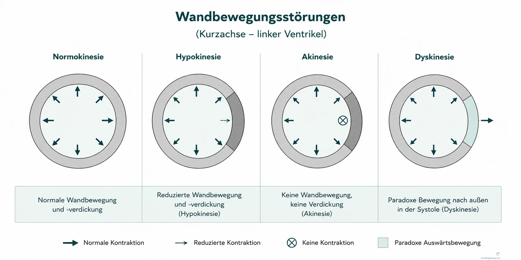 Schematische Darstellung regionaler Wandbewegungsstörungen im Kurzachsenschnitt: Normokinesie, Hypokinesie, Akinesie und Dyskinesie